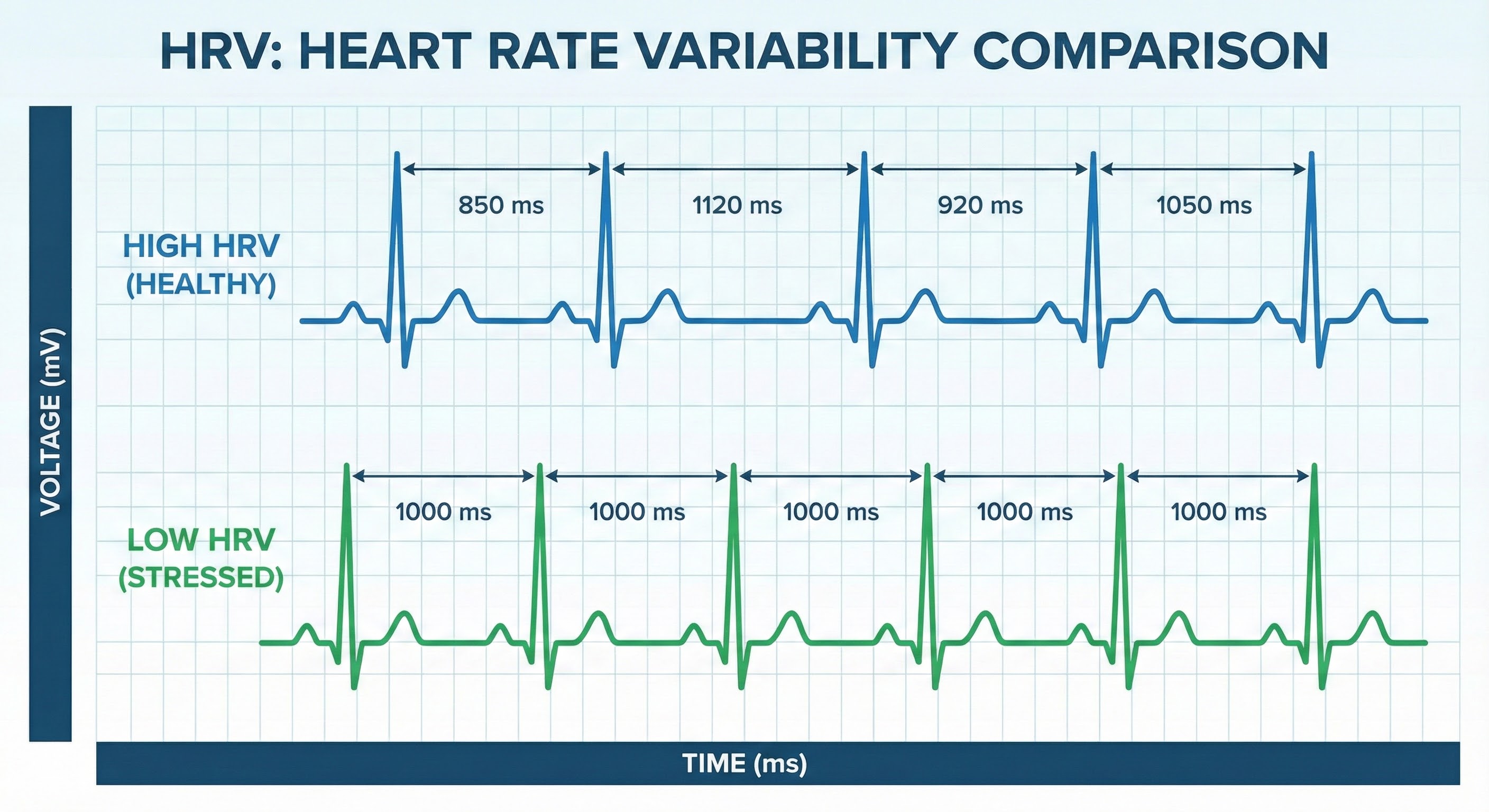 ECG trace showing variable R-R intervals between heartbeats