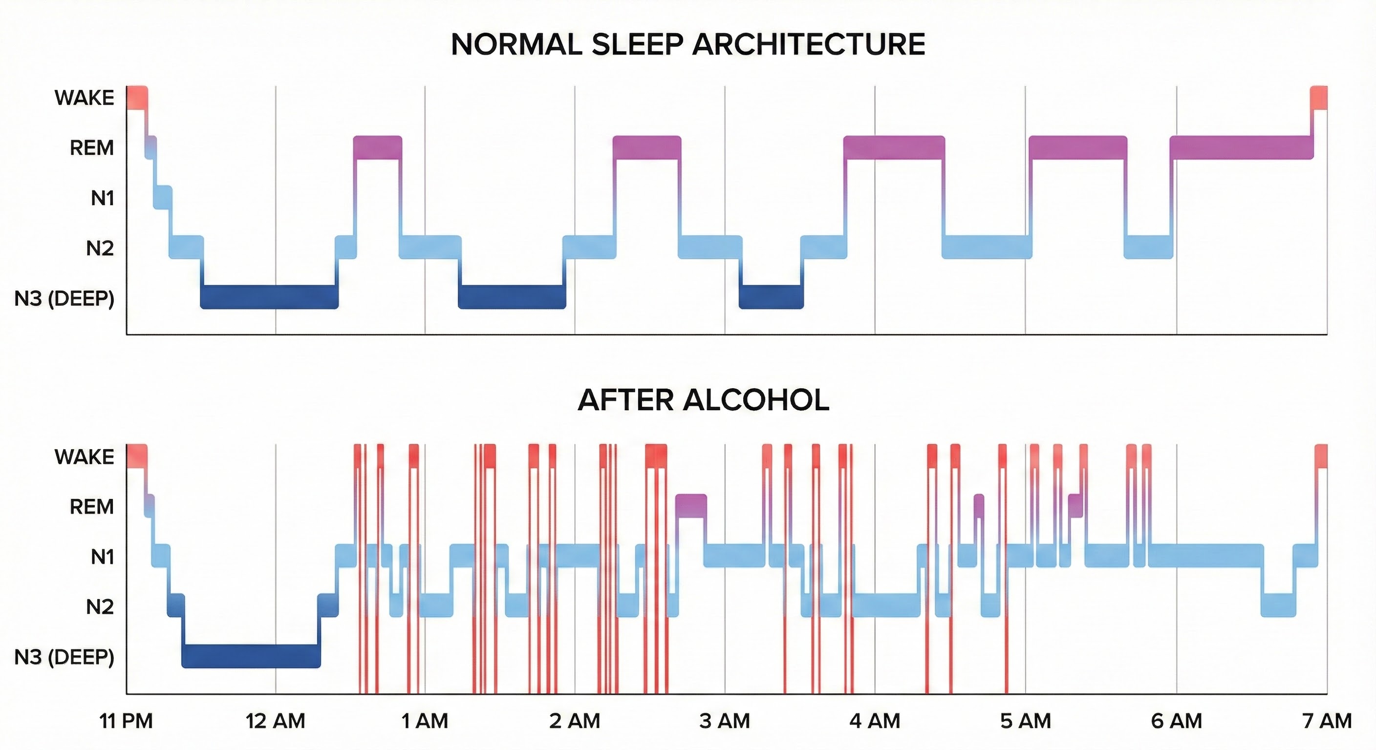 Sleep stage comparison showing alcohol's impact on sleep architecture